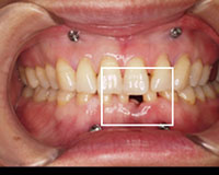 歯茎の中にピンを入れました
