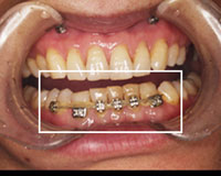 インプラント矯正で飛び出た部分を下に