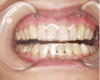 目立たない矯正装置クリアアライナー