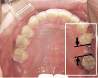インプラントが入るスペースを作ります