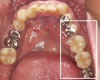 治療後の下の歯
