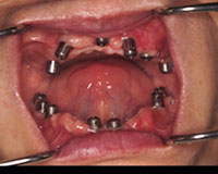 インプラント埋没後