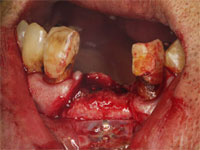 インプラント手術の様子