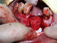 インプラント手術の様子