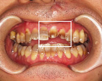 神経を取らずに歯の表面を削ったところ
