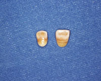 ラミネートベニア（セラミック）