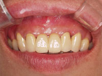 かぶせもののつけかえ