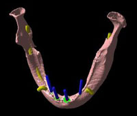 顎の状態を3D立体構築画像で見た状態