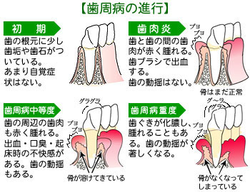 歯周病の進行