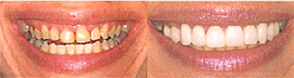 左）やや八重歯になって変色気味の歯でした。右）審美治療の結果、白く綺麗に整いました。