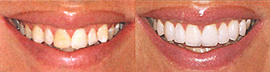 左）古い差し歯や着色の歯、八重歯でした右）審美治療の結果、白く整った歯になりました。