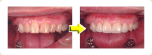 左）古い詰め物が所々に詰まっており歯の色も変色しています。右）前歯4本をラミネートベニヤ治療後です。